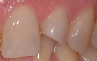 dentistica conservativa prima