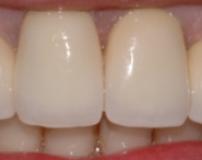 protesi fissa estetica dentale dopo